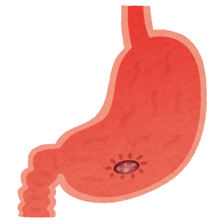 胃・十二指腸潰瘍って何でしょう？